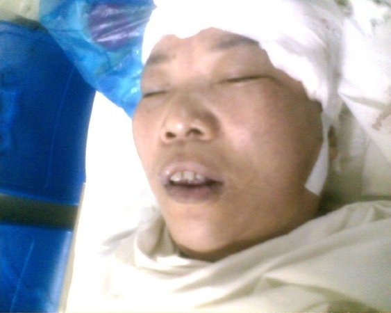 Пострадавшую от избиений полицейскими Чэнь Юймэй в тяжёлом состоянии доставили в больницу