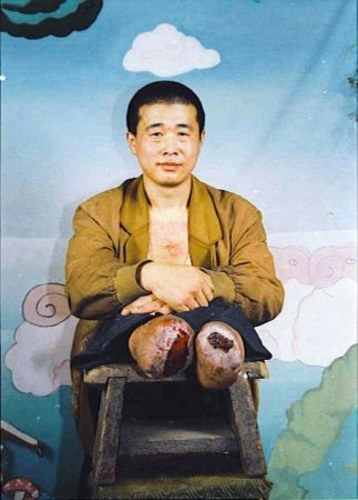 Ван Синьчунь в результате преследования потерял обе ноги