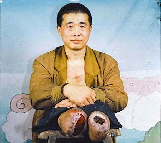 Ван Синьчунь, последователь Фалуньгун из провинции Хэйлунцзян, лишившийся ног в результате преследования