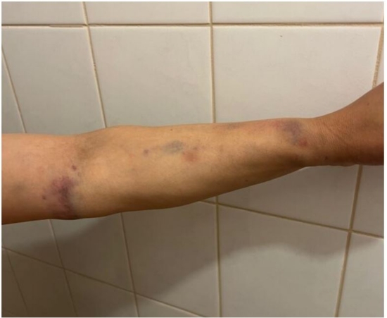Травмы, полученные канберрской женщиной во время нападения, 4 октября 2022 года в Канберре, Австралия. (прилагается)